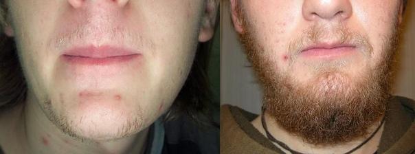 Борода до и после Миноксидила