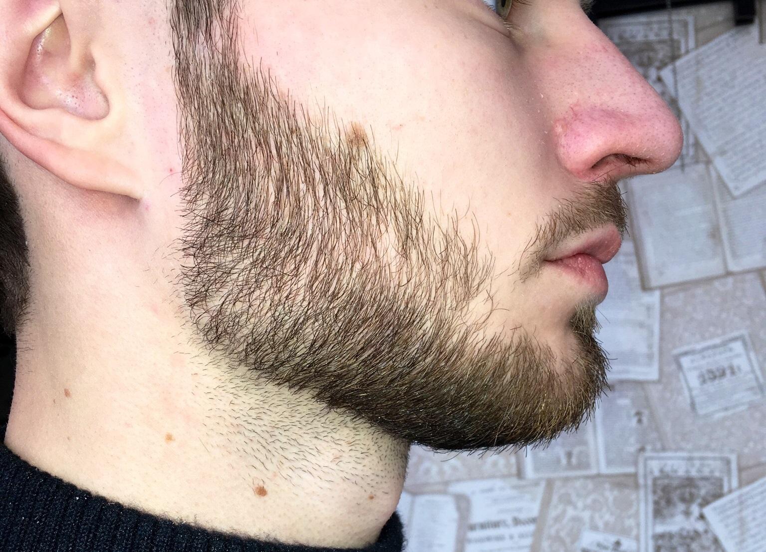 не растет борода в 18