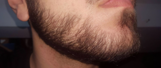 борода растет с одной стороны
